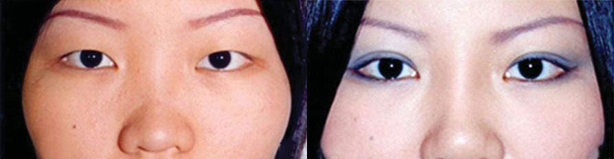 Asian Double Eyelid Before and After Photo by Dr. Glavas in Boston Massachusetts