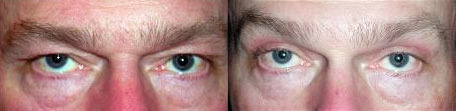 Brow Lift Before and After Photo by Dr. Glavas in Boston Massachusetts