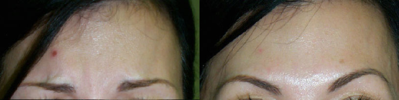Brow Lift Before and After Photo by Dr. Glavas in Boston Massachusetts