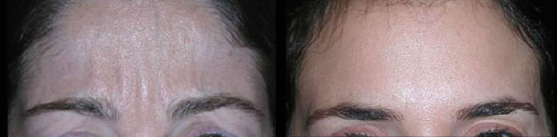 Brow Lift Before and After Photo by Dr. Glavas in Boston Massachusetts