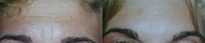 Brow Lift Before and After Photo by Dr. Glavas in Boston Massachusetts