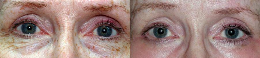 Eye Lift Before and After Photo by Dr. Glavas in Boston Massachusetts