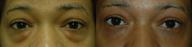 Eye Lift Before and After Photo by Dr. Glavas in Boston Massachusetts