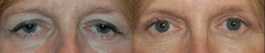 Eye Lift Before and After Photo by Dr. Glavas in Boston Massachusetts