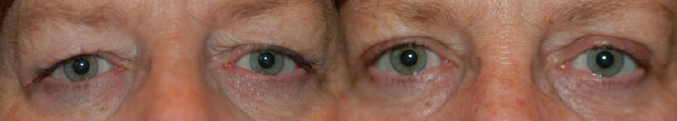 Eye Lift Before and After Photo by Dr. Glavas in Boston Massachusetts