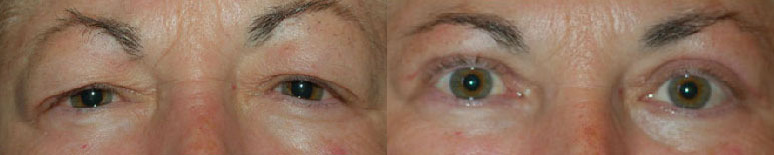 Eye Lift Before and After Photo by Dr. Glavas in Boston Massachusetts