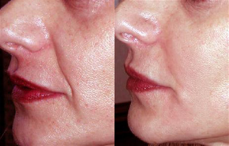 Fillers Before and After Photo by Dr. Glavas in Boston Massachusetts