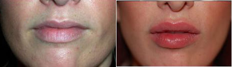 Fillers Before and After Photo by Dr. Glavas in Boston Massachusetts