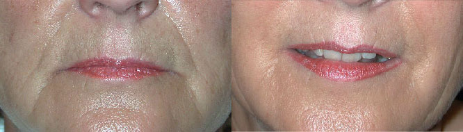 Fillers Before and After Photo by Dr. Glavas in Boston Massachusetts