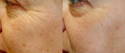 Laser Skin Resurfacing Before and After Photo by Dr. Glavas in Boston Massachusetts