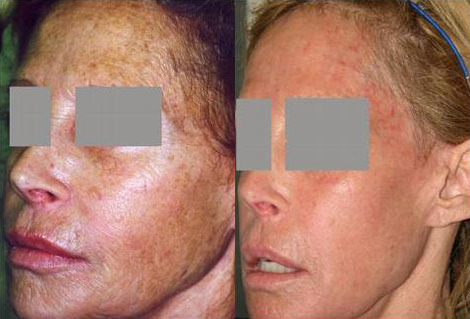 Laser Skin Resurfacing Before and After Photo by Dr. Glavas in Boston Massachusetts