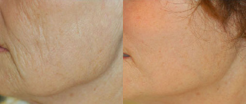 Mid-Face Lift Before and After Photo by Dr. Glavas in Boston Massachusetts