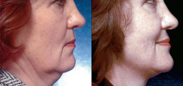 Mid-Face Lift Before and After Photo by Dr. Glavas in Boston Massachusetts