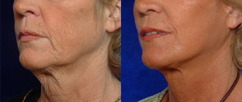 Mid-Face Lift Before and After Photo by Dr. Glavas in Boston Massachusetts