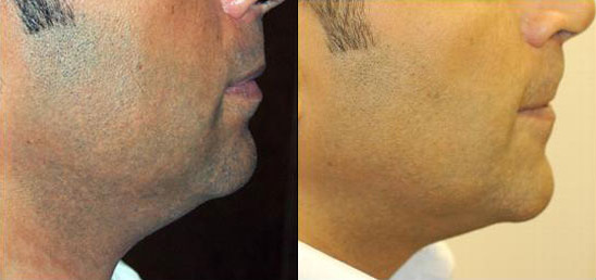 Neck Lift Before and After Photo by Dr. Glavas in Boston Massachusetts