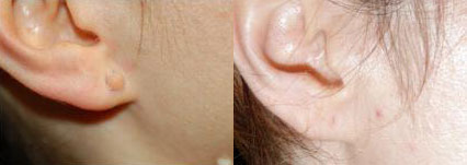 Scar-Less Mole Removal Before and After Photo by Dr. Glavas in Boston Massachusetts
