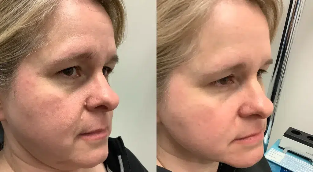 Scar-less Mole Removal Before and after photo by Dr. Glavas in Boston, MA