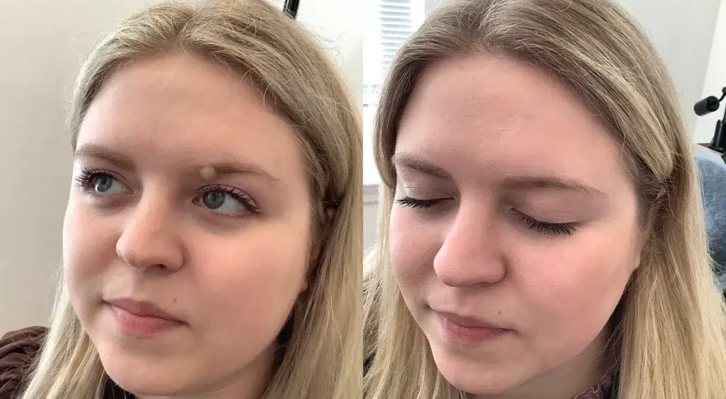 Scar-less Mole Removal Before and after photo by Dr. Glavas in Boston, MA