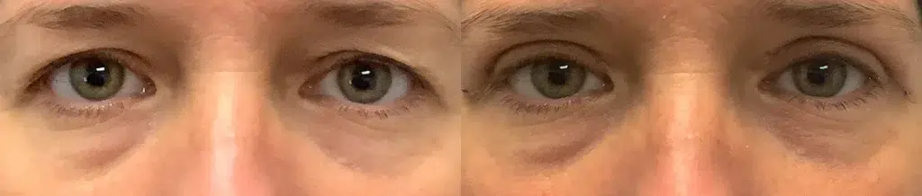 Eyelid Lift Before and after photo by Dr. Glavas