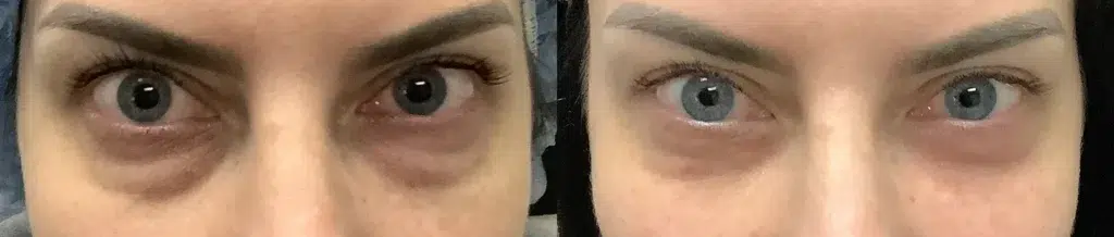 Eyelid Lift Before and after photo by Dr. Glavas