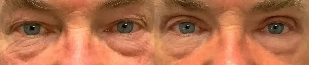 Eyelid Lift Before and after photo by Dr. Glavas