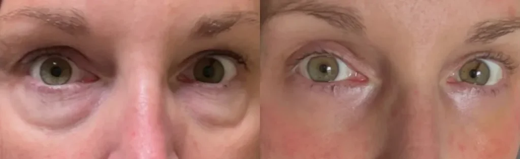 Lower Eyelid Lift Before and after photo by Dr. Glavas